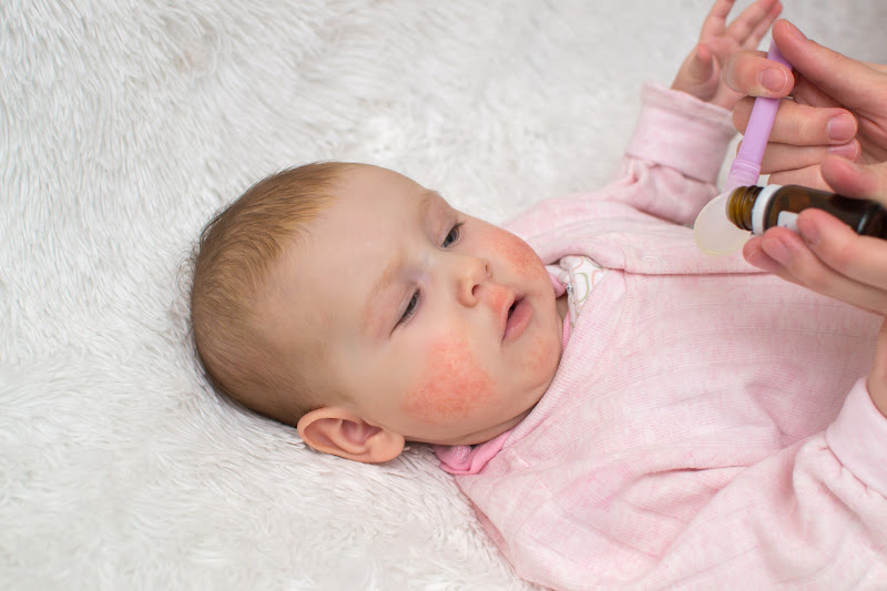 Rashes on baby's skin