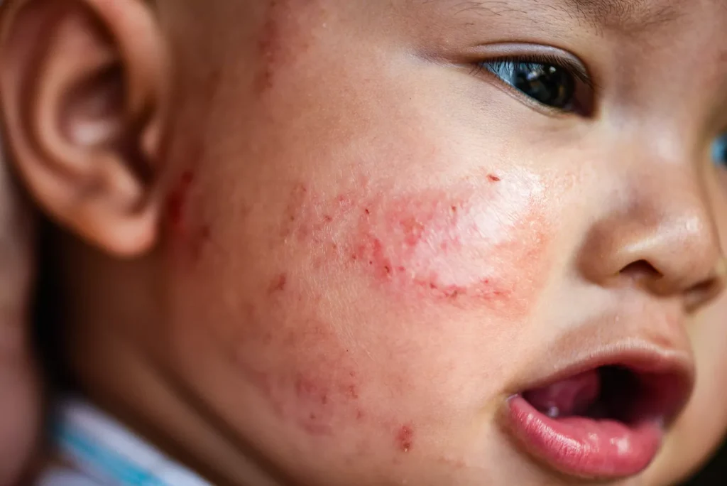 Eczema in children