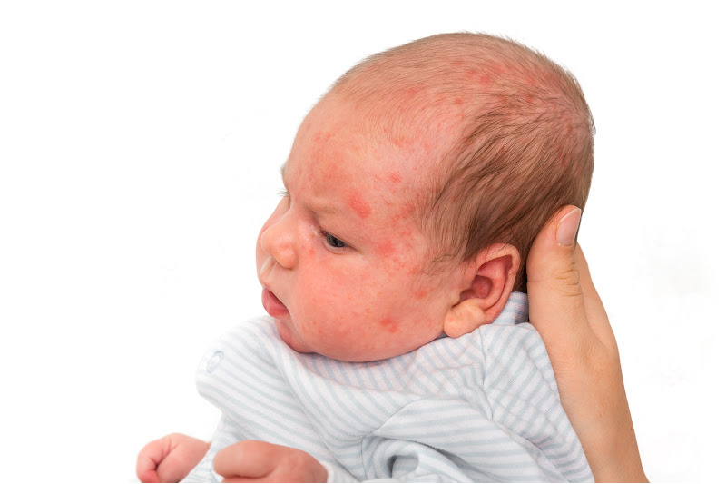 Eczema on baby face