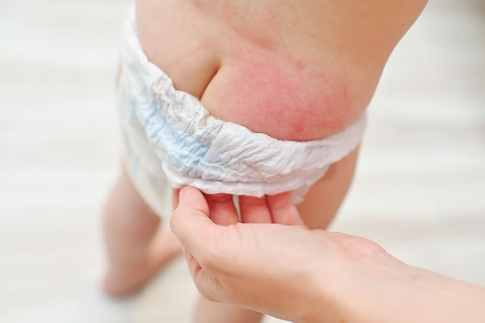 Rash on baby butt