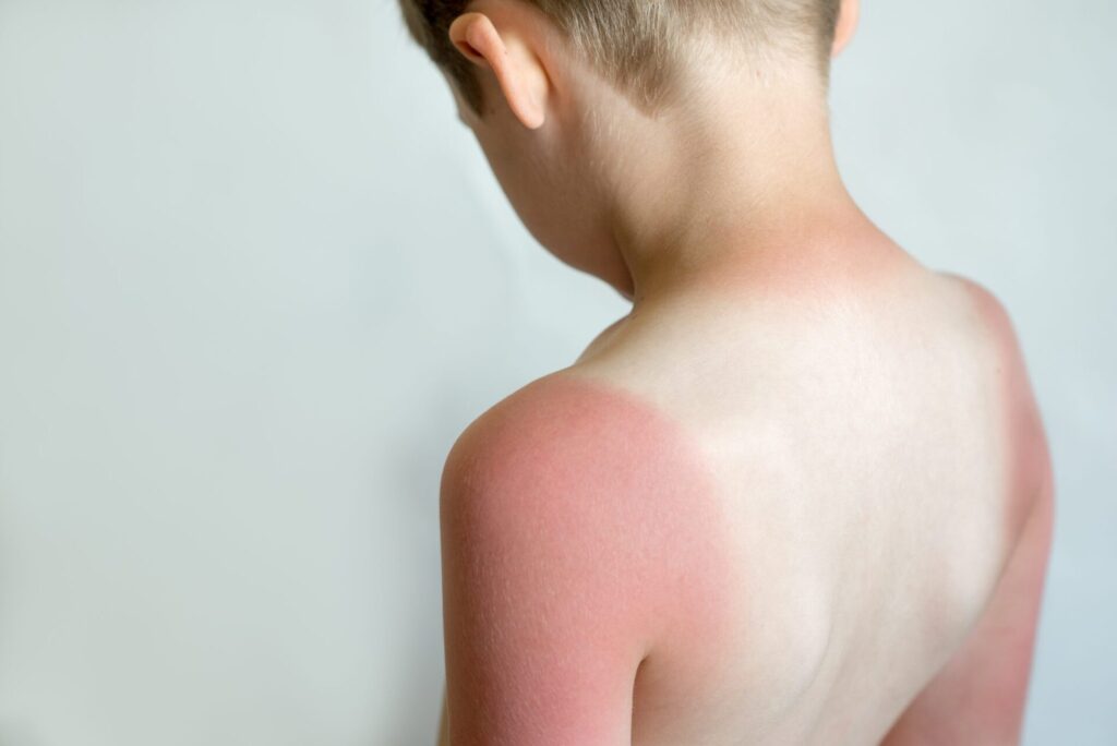 A young boy shows a sunburn on his back, indicating overexposure to sunlight.